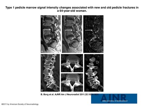 Type 1 pedicle marrow signal intensity changes associated with new and ...