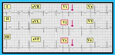 T wave inversion, Juvenile T wave variant, pulmonary embolism : 네이버 블로그