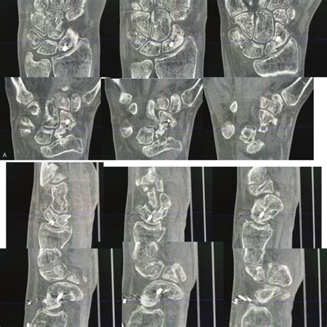 Customized scaphoid cast during bone stimulation therapy. | Download Scientific Diagram