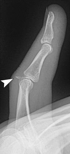 Avulsion Fracture Hand