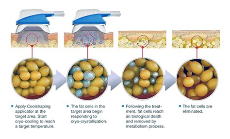 360 Cryo-Sculpting – K Wellness of the Rockies