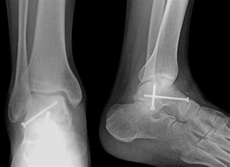 Subtalar dislocation | The Foot and Ankle Online Journal