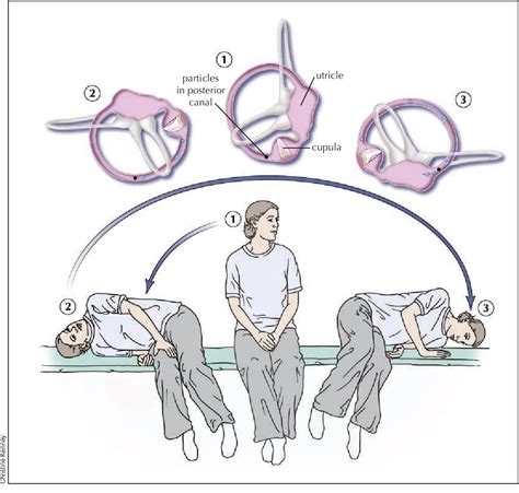 Benign paroxysmal positional vertigo epley maneuver - learningmens