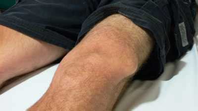 Kneecap Dislocation | Singapore Sports and Orthopaedic Clinic & Neurosurgeon