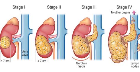 You’re Probably Not Aware Of These Advanced Stages Of Chronic Kidney Disease