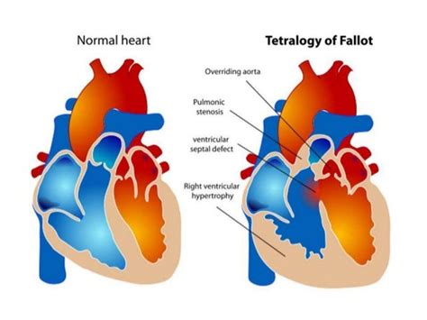 Paediatric Cardiac Surgery in Delhi