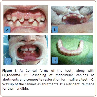 Ectodermal Dysplasia Teeth