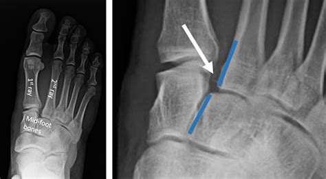 LisFranc Injury | Orthopaedic Trauma Association (OTA)