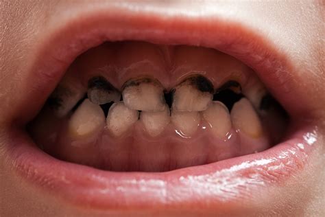 Trial shows biannual application of silver diamine fluoride better than annual application at ...