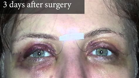 Upper Eyelid Surgery - After Photos 3 Days Post Surgery | 8 West Clinic ...