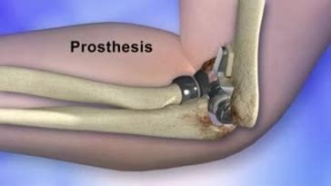 Elbow Arthroplasty: Types, Procedure, Recovery, And FAQs, 41% OFF