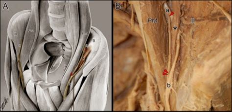 Lesions of the Femoral Nerve