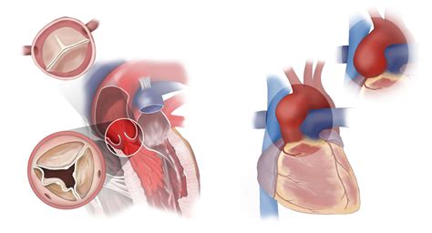 HAART Aortic Valve Repair Technologies – BioStable Science & Engineering