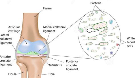 Knee Infection Melbourne, Malvern & Werribee | MOATI