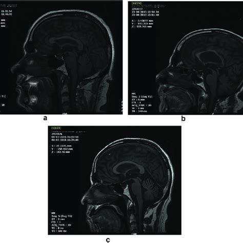 Thickness of pars compacta of substantia nigra measured as a... | Download Scientific Diagram