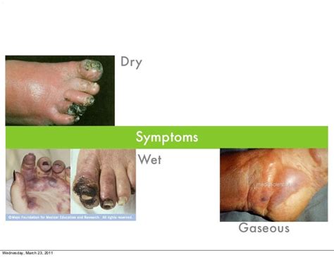 Gangrene symptoms