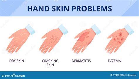 Hand Skin Problems. Dry Skin with Cracks, Dermatitis and Eczema Stock Vector - Illustration of ...