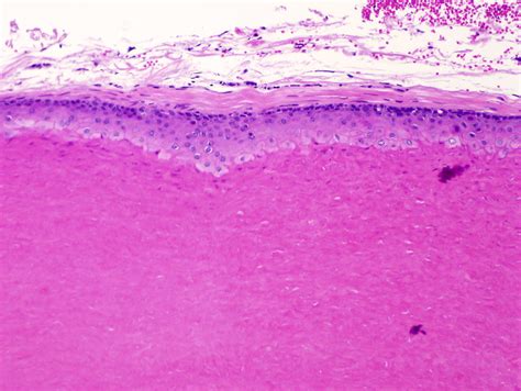 Pathology Outlines - Trichilemmal (pilar) type