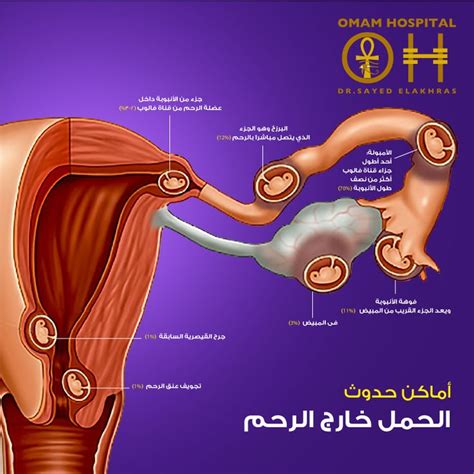 يحدث الحمل خارج الرحم عندما تزرع المضغة في مكان آخر غير بطانة الرحم من ...