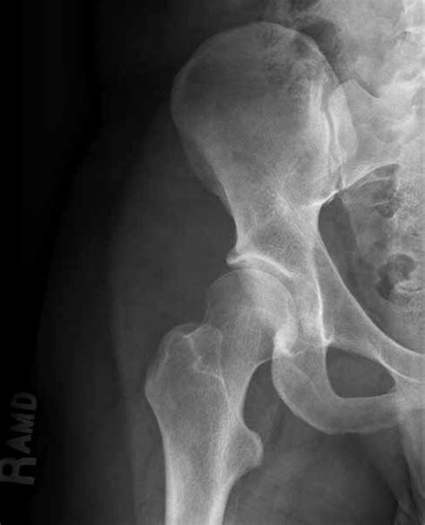 AP radiograph of the right hip demonstrating coxa valga and a femoral ...