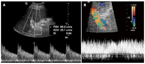 Hepatic Artery Ultrasound