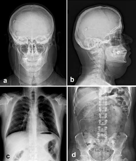 [Figure, Shunt series including biplanar head...] - StatPearls - NCBI Bookshelf