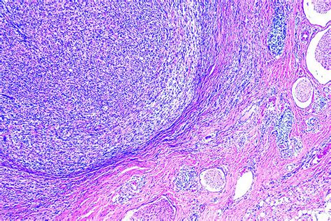 Pathology Outlines - Malignant peripheral nerve sheath tumor (MPNST)