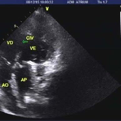 Electrocardiogram of d-TGA and right ventricular hypertrophy signs. | Download Scientific Diagram