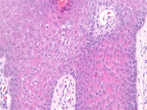 Spongiotic Dermatitis Histology