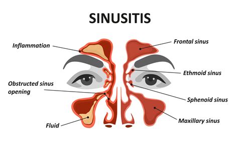 Functional Endoscopic Sinus Surgery (FESS)