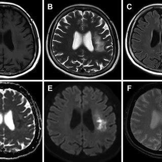 Brain MRI ten months later. White matter lesion appears in left middle ...