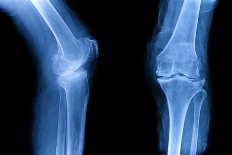 Treating knee osteoarthritis without surgery - Northwestern Now