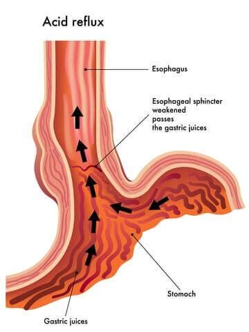 Lap-Band Problems and Complications - The Complete List - Bariatric ...