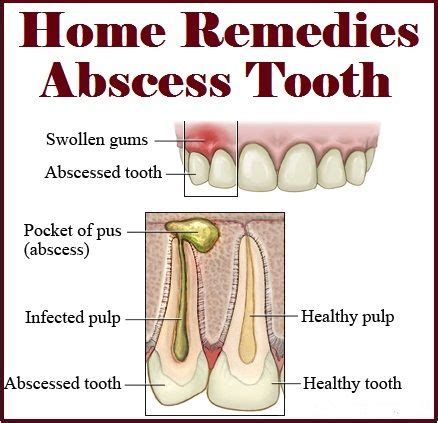 Home Remedies For Gum Infection After Tooth Extraction | Home and Garden Reference