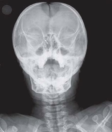 Open anterior fontanelle | Download Scientific Diagram