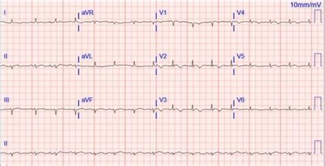 Electrocardiogram showing normal sinus rhythm, left axis deviation, low ...