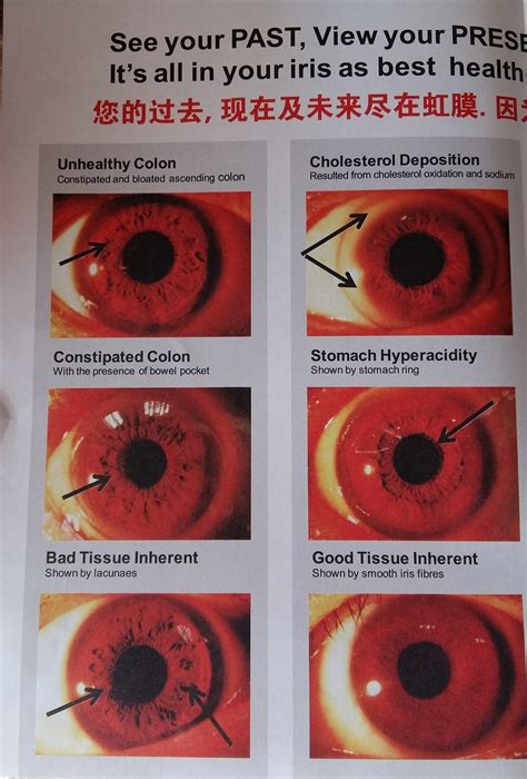 Iridology- diagnosis of past, present and future illness from the iris (charts and photos ...