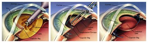 Refractive Lens Exchange - Graystone iLasik