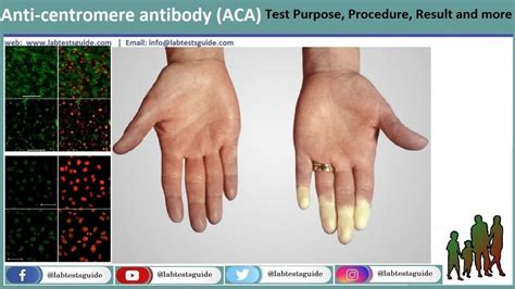 Centromere Antibody Test | Lab Tests Guide