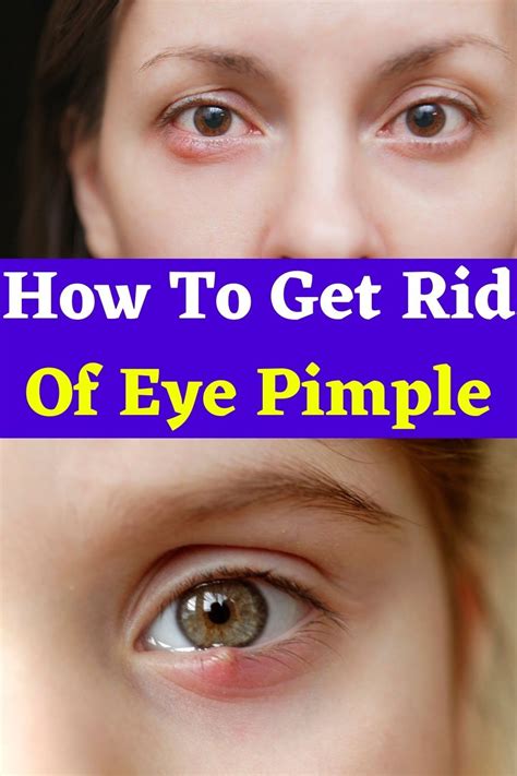 How To Get Rid Of Eye Pimple in 2021 | Pimples, Common eye problems ...