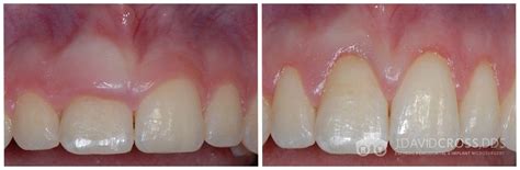 Springfield Esthetic Crown Lengthening Before And After Photos | J. David Cross, DDS