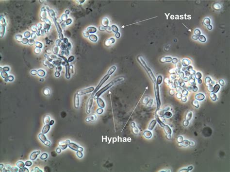 Urine Sediment of the Month: Microorganisms - Renal Fellow Network