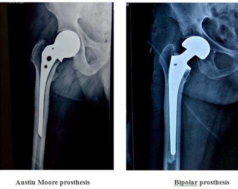 Figure From Bipolar Or Unipolar Hemiarthroplasty After, 46% OFF