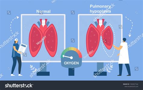 13 Pulmonary hypoplasia Images, Stock Photos & Vectors | Shutterstock