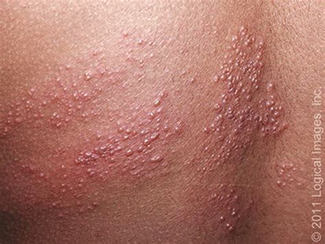 SHINGLES: What You Need to Know | Generations Magazine
