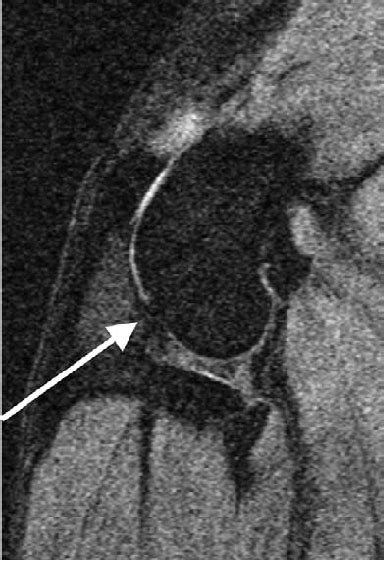 Defect of articular cartilage contour at the lateral femoral condyle,... | Download Scientific ...