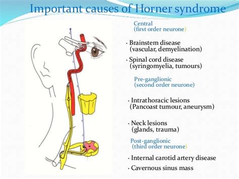 horner syndrome causes - DriverLayer Search Engine