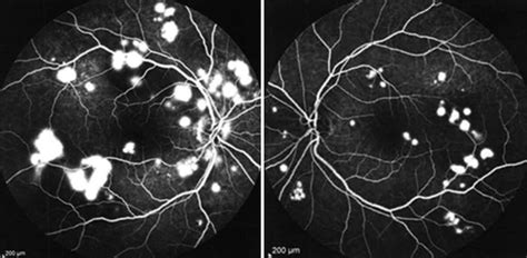 Fluorescein angiography of the right (1a) and the left eye (1b) at... | Download Scientific Diagram