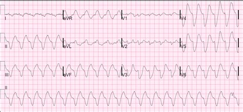 Dr. Smith's ECG Blog: The Effect of Calcium on Severe Hyperkalemia