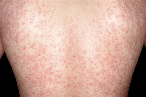 Pityriasis rosea - NHS